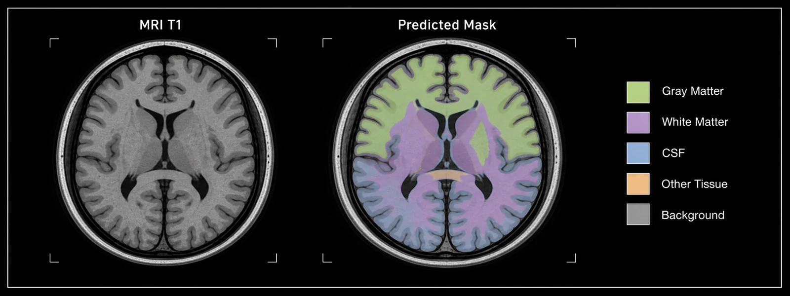 MRI segmentation comparison with a grayscale scan, predicted mask, and tissue legend.